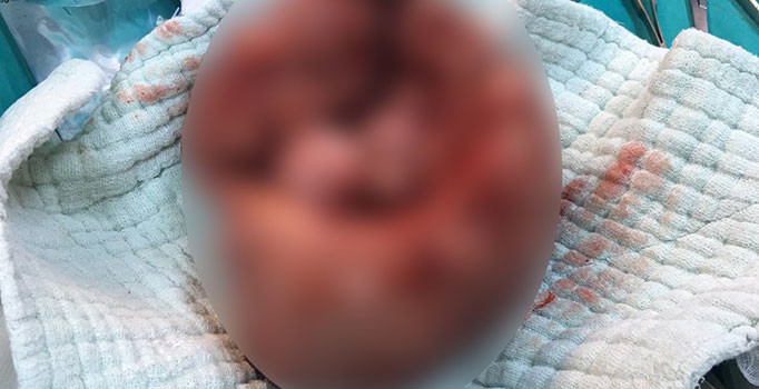 Bingöl’de doğum yapan kadının karnından 6.5 kiloluk ur çıkarıldı