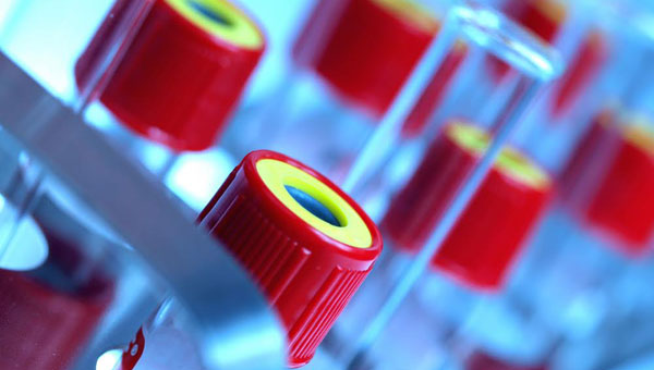 Deride koyulaşma talasemi habercisi olabilir